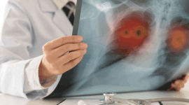 Ilustrasi CT Scan. Banyak mitos tentang kanker paru membuat orang merasa tidak berisiko, padahal penyakit ini bisa terjadi pada siapa saja dan sering terlambat terdeteksi.(SHUTTERSTOCK/create jobs 51)