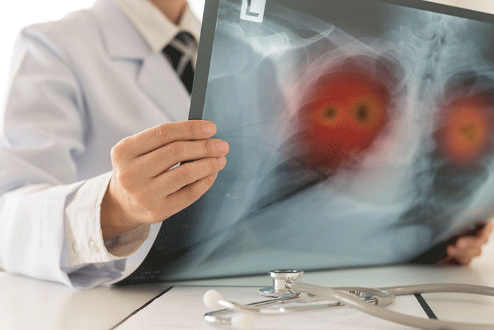Ilustrasi CT Scan. Banyak mitos tentang kanker paru membuat orang merasa tidak berisiko, padahal penyakit ini bisa terjadi pada siapa saja dan sering terlambat terdeteksi.(SHUTTERSTOCK/create jobs 51)